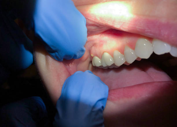 Best Emergency Treatment for Toothache in Shady Spring, WV